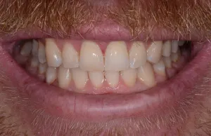 Mouth after Invisalign