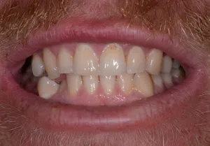 Mouth before Invisalign