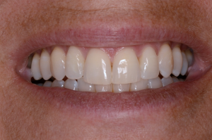 Mouth after Invisalign