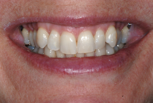 Mouth before Invisalign