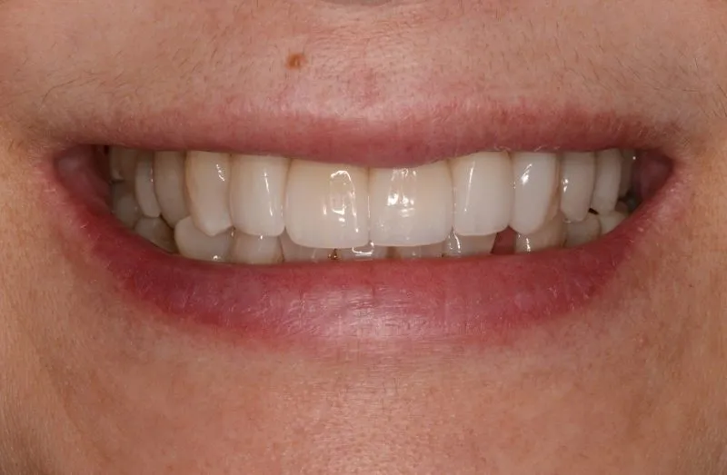 Straight smile after veneers