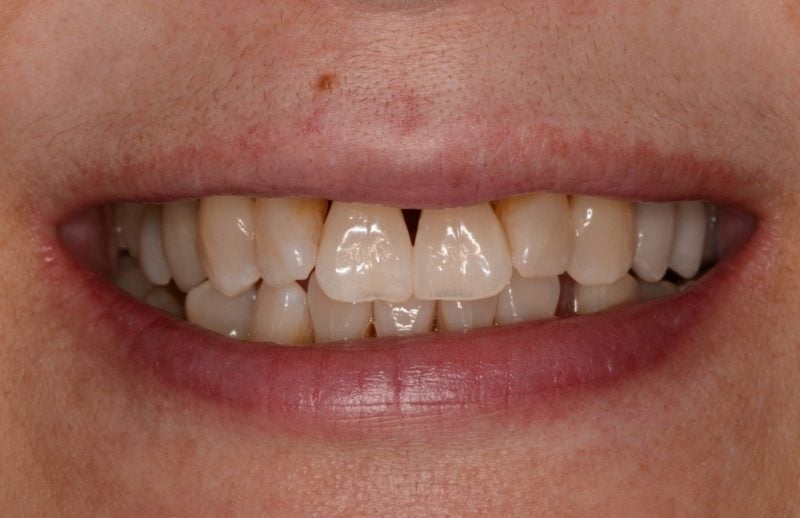 Uneven smile with tooth gap before veneers