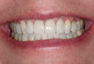 Mouth after Invisalign