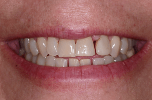 Mouth before Invisalign