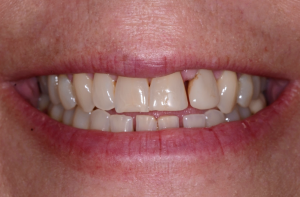 Mouth before Invisalign