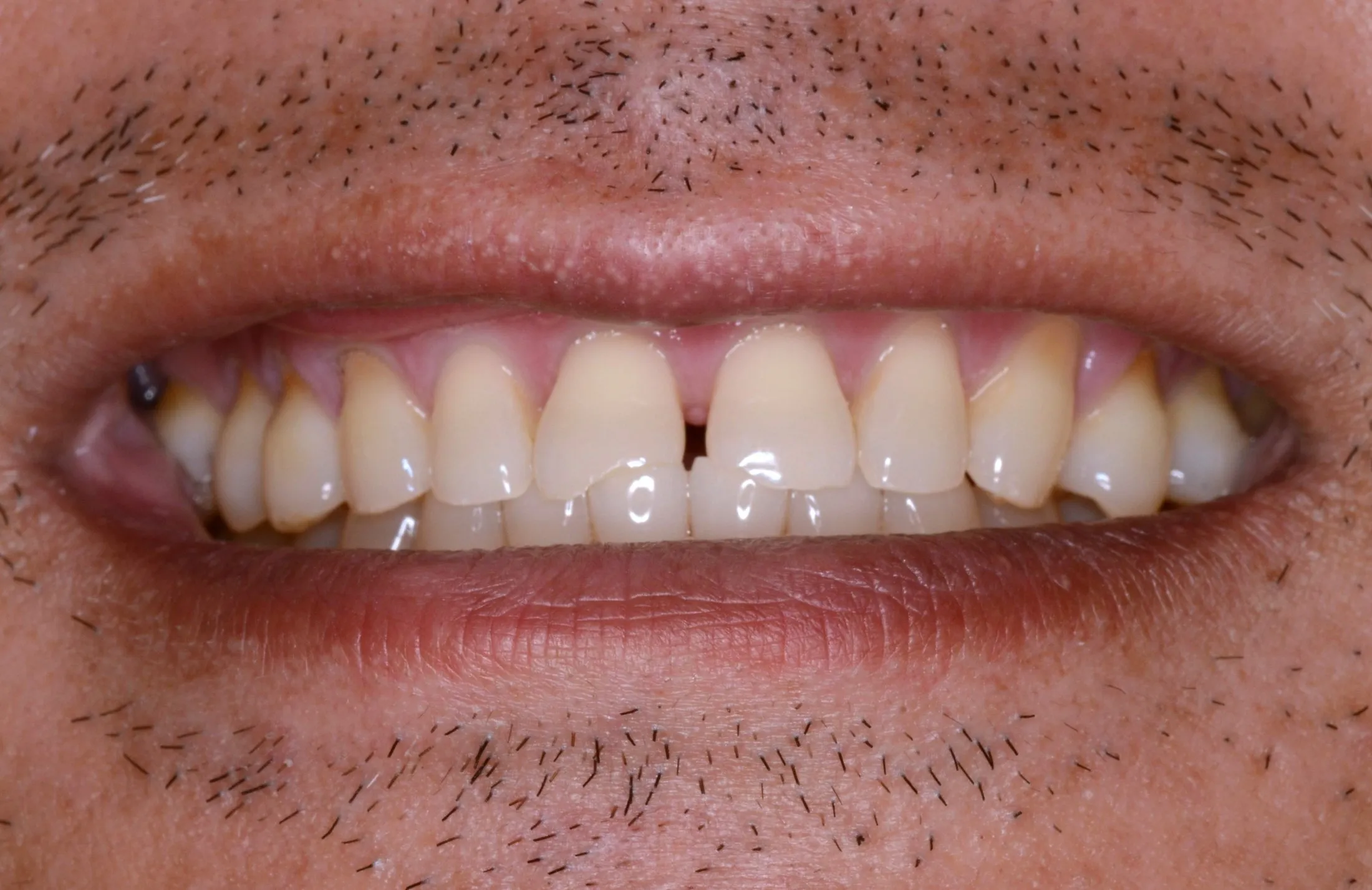 Upper anterior teeth with midline diastema, mild crowding, and yellowish enamel; gingiva pink and stippled