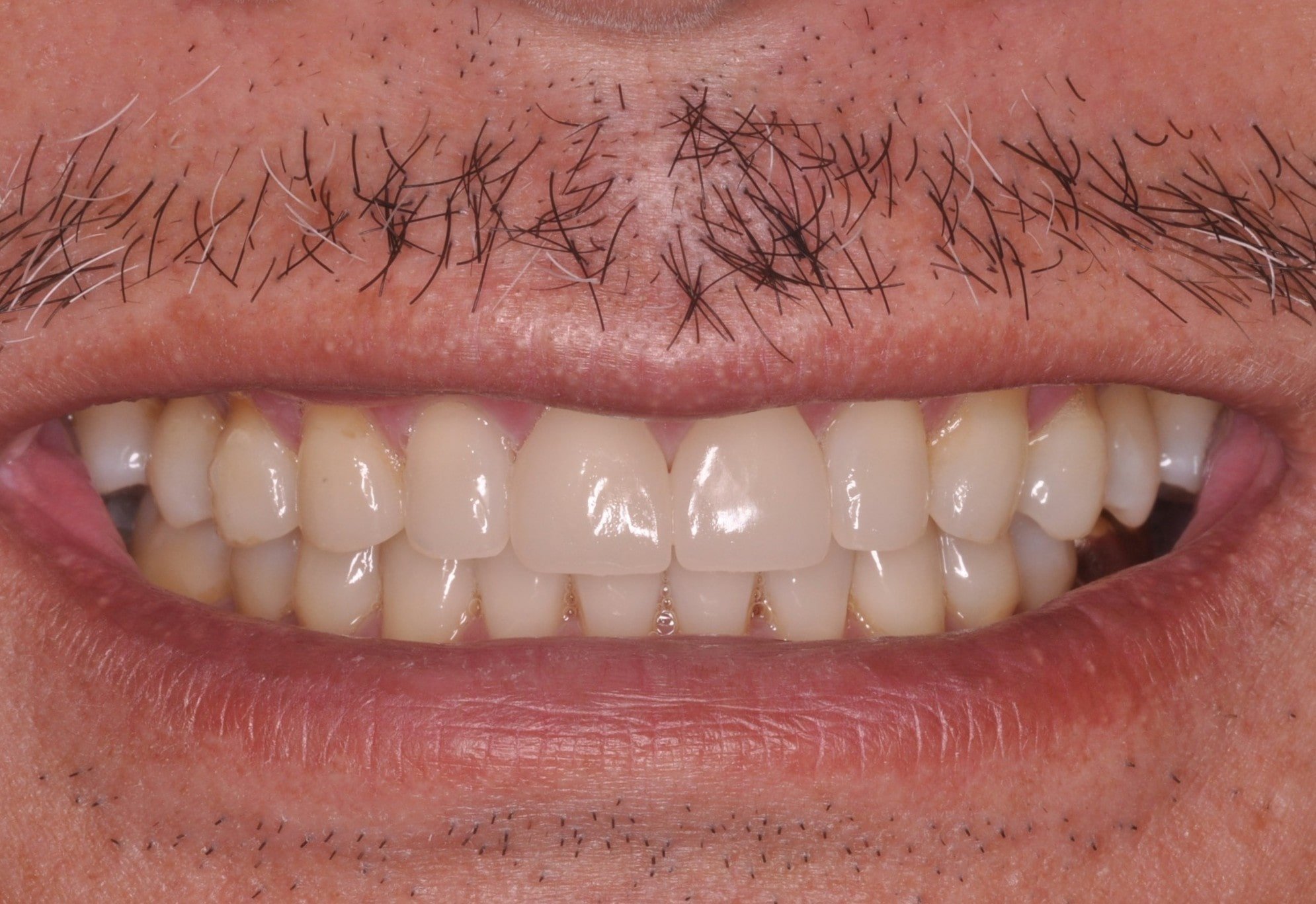 Smile showing upper incisors with slight rotation, uneven wear facets, and natural shade variation; lip line relaxed