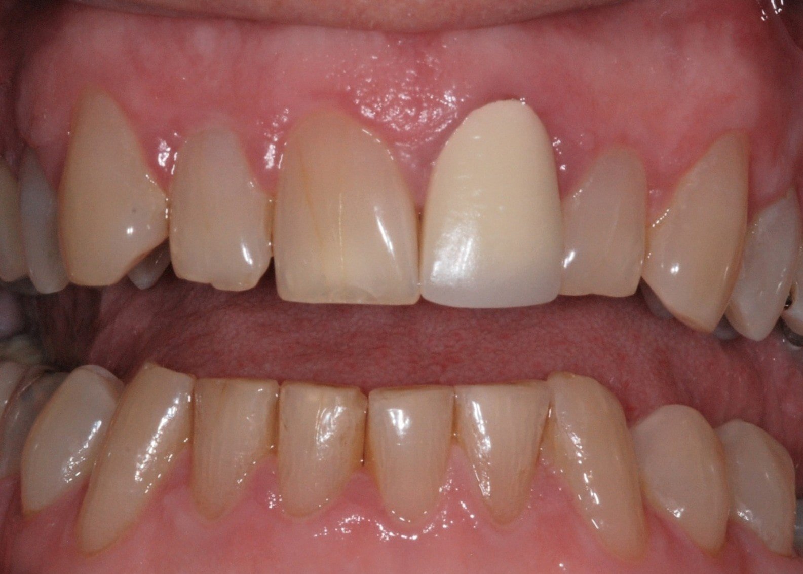 Close-up of upper arch: central incisors appear restored with uniform opacity; laterals show minor discoloration and chipping