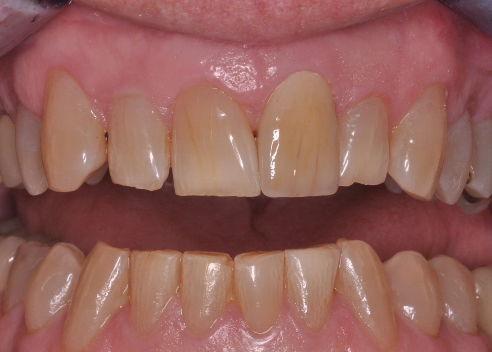 Full upper dentition with generalized yellow staining, irregular incisal edges