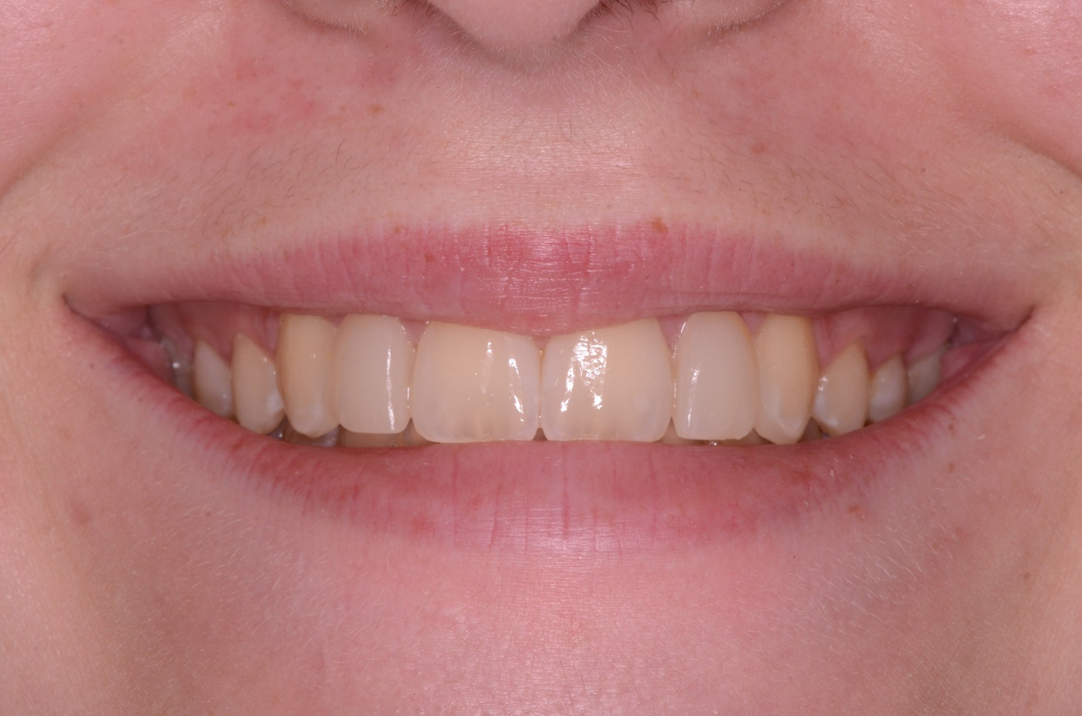 Smile displaying upper incisors with mild discoloration, minor irregularities in alignment, and intact interdental papillae