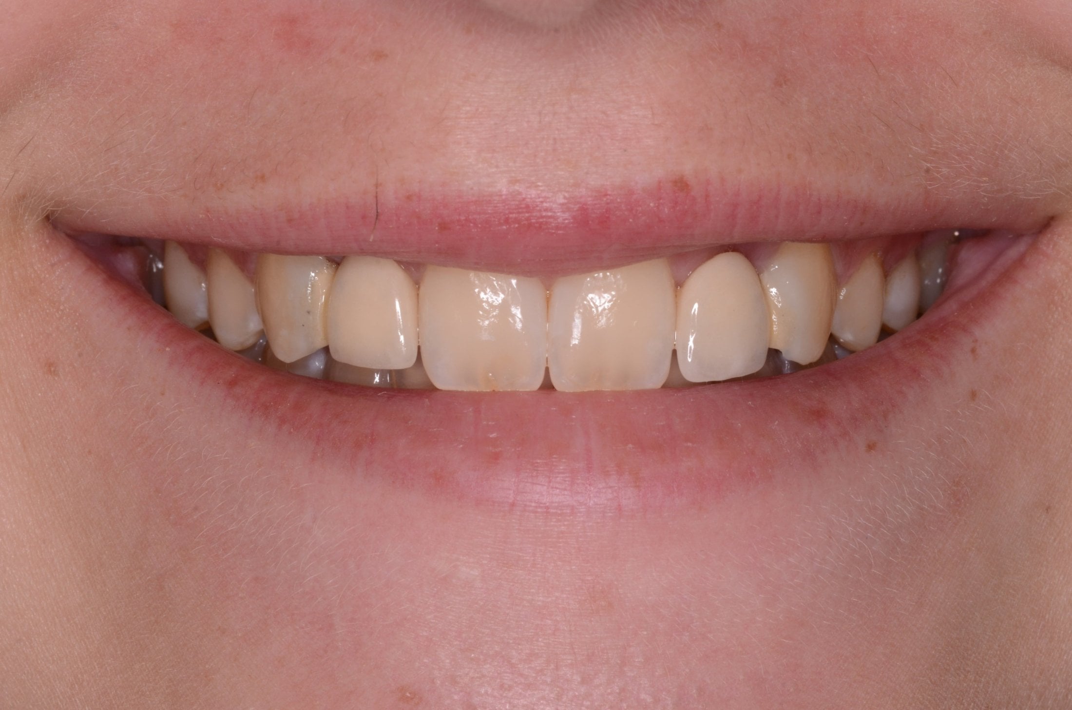 Smile showing upper anterior teeth with natural shade variation, slight yellowing, even incisal edges, and healthy pink gingiva