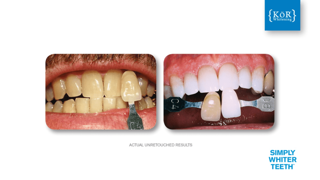 Left—crowded, worn upper anteriors; right—aligned, reshaped incisors with ceramic veneers; [KOR] branding visible top-right