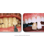 Left—crowded, worn upper anteriors; right—aligned, reshaped incisors with ceramic veneers; [KOR] branding visible top-right