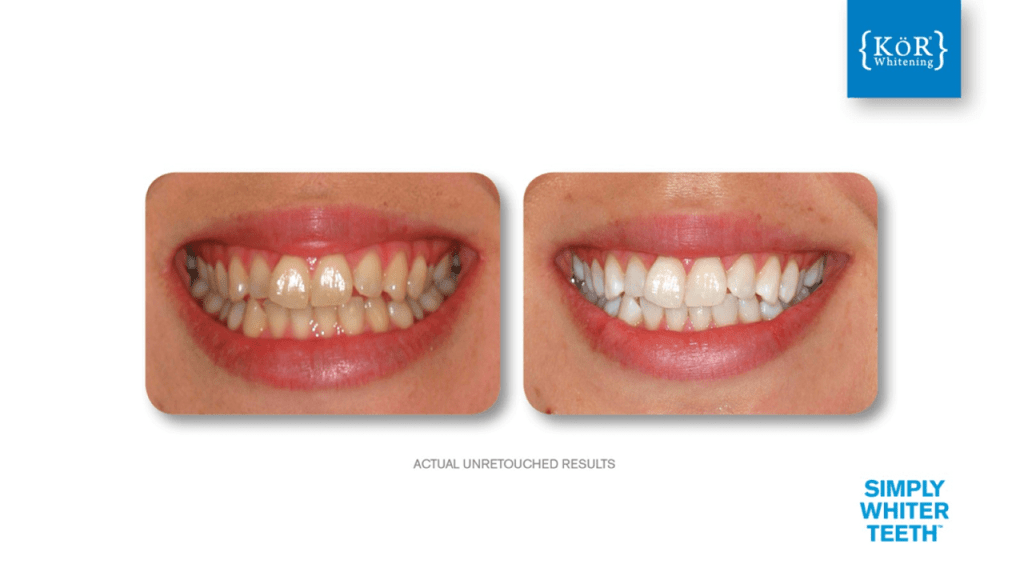 Left—yellowed upper teeth with uneven edges; right—brighter, symmetric smile; “ACTUAL UNRETouched RESULTS” caption present