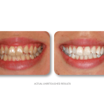 Left—yellowed upper teeth with uneven edges; right—brighter, symmetric smile; “ACTUAL UNRETouched RESULTS” caption present