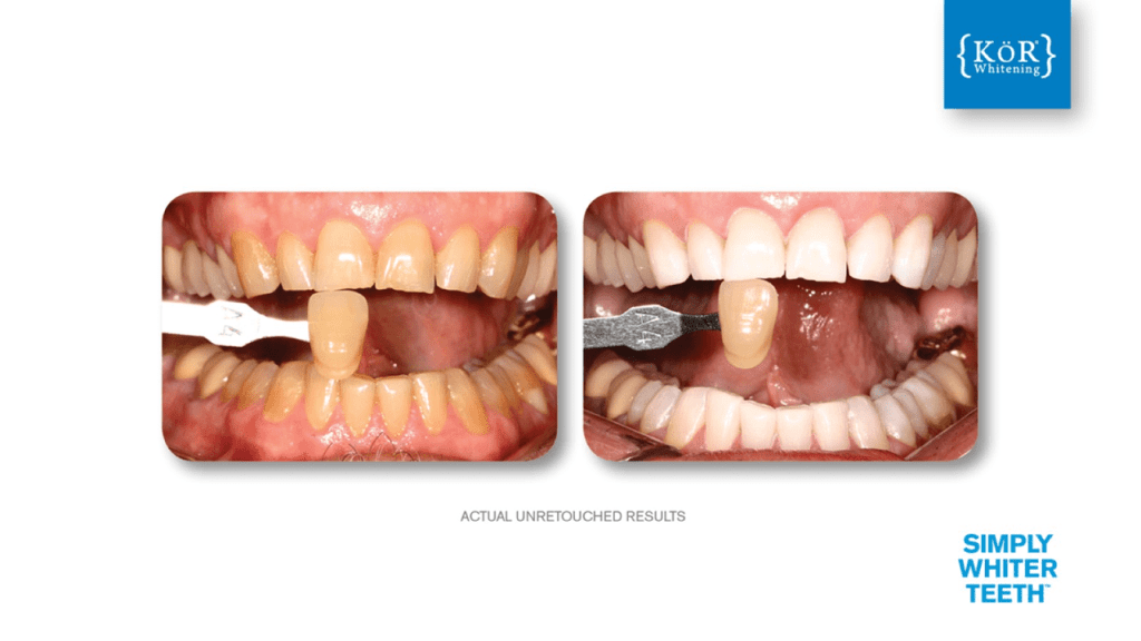 Left—severe discoloration and chipping on upper centrals; right—whiter, restored incisors; [KOR] logo and “SIMPLY WHITER TEETH” below