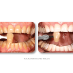 Left—severe discoloration and chipping on upper centrals; right—whiter, restored incisors; [KOR] logo and “SIMPLY WHITER TEETH” below