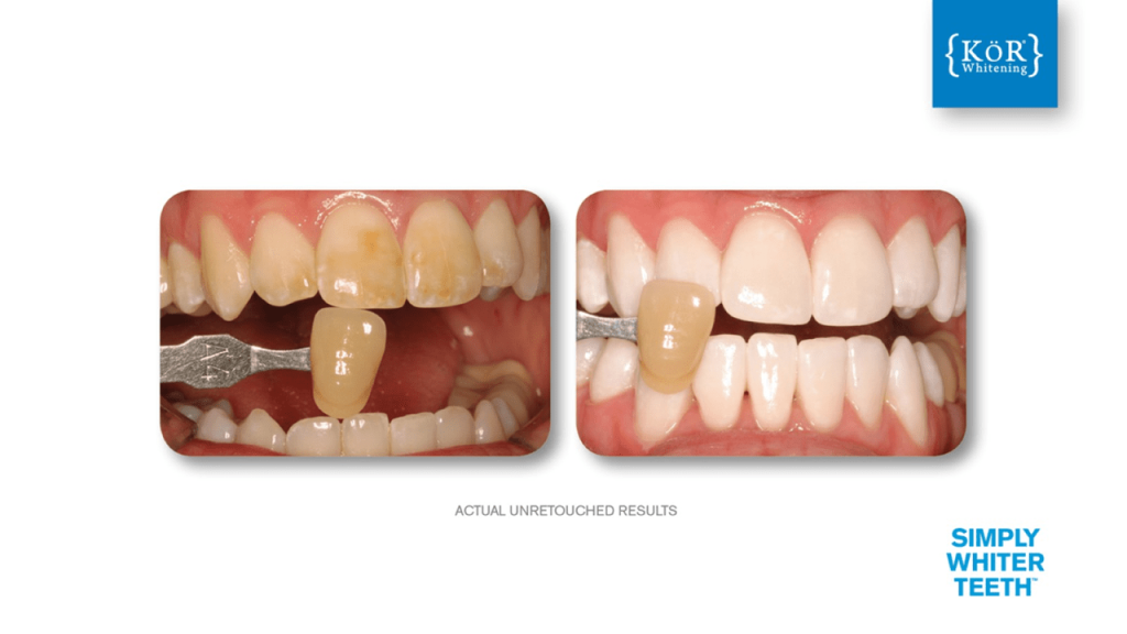 teeth whitening before & after pictures