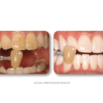 teeth whitening before & after pictures