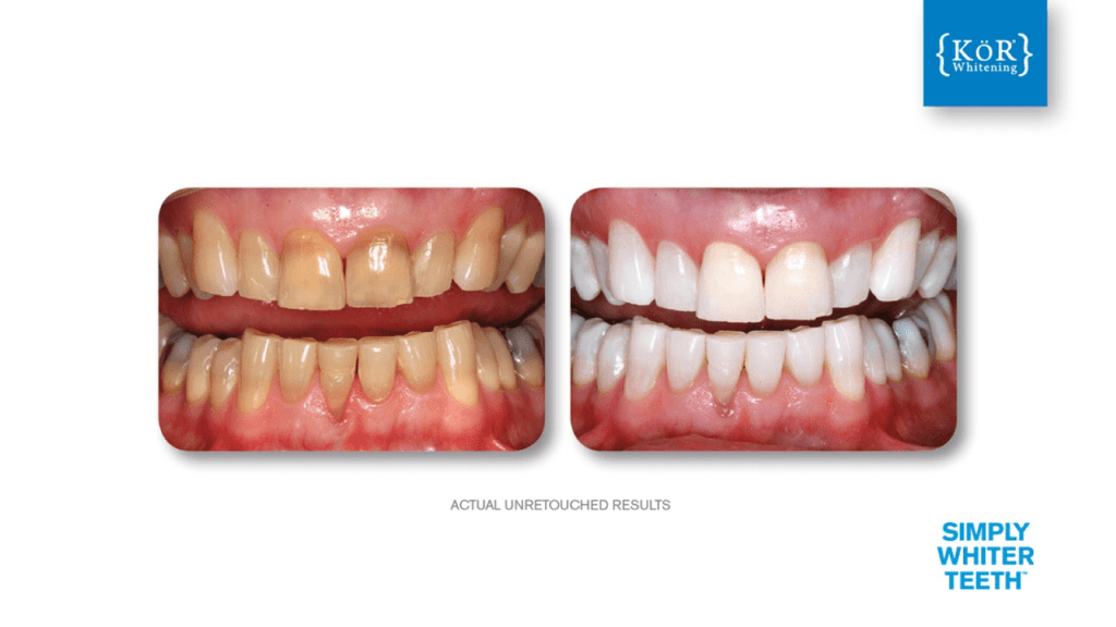 Left—stained lower/upper teeth with diastema; right—uniform shade, closed gap, natural translucency; tagline at bottom