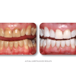 Left—stained lower/upper teeth with diastema; right—uniform shade, closed gap, natural translucency; tagline at bottom
