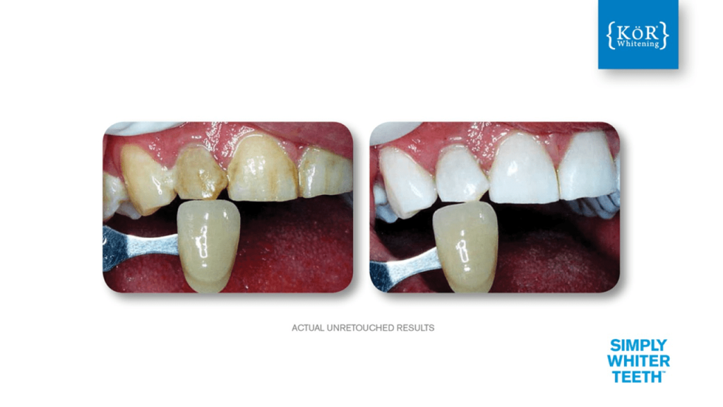 Left—fractured upper right central with discoloration; right—intact, esthetically restored tooth; “SIMPLY WHITER TEETH” in blue