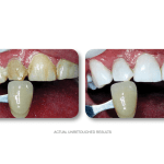 Left—fractured upper right central with discoloration; right—intact, esthetically restored tooth; “SIMPLY WHITER TEETH” in blue